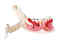 HG-N14 Mandibular tissue decomposition model